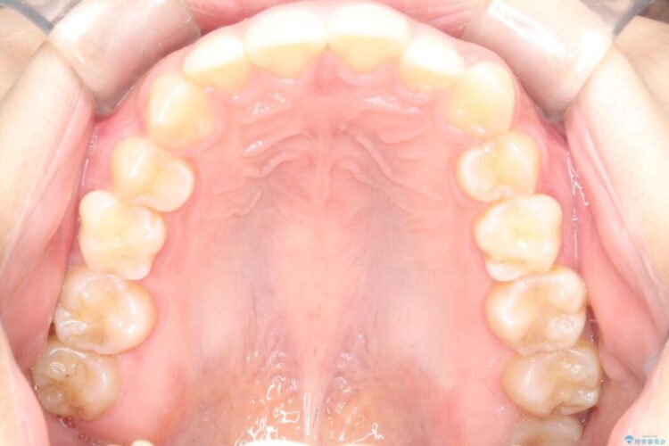 【ワイヤー矯正】前歯の叢生(ガタガタ)をなおす 治療前画像