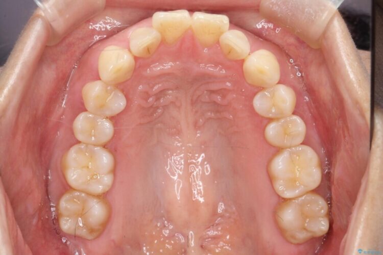 出っ歯をインビザラインで改善 治療前画像