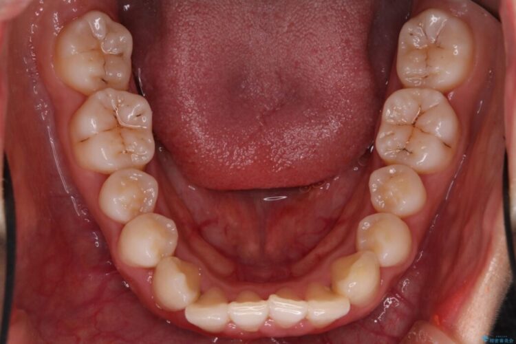気になる飛び出た八重歯を歯科矯正で治したい 治療前画像