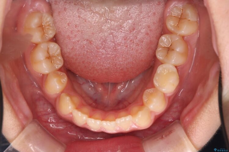 【インビザライン】未萌出の永久歯と八重歯をなおしたい。 治療前画像
