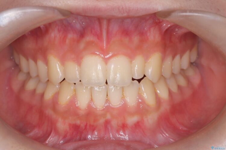 【インビザライン】未萌出の永久歯と八重歯をなおしたい。 治療後画像