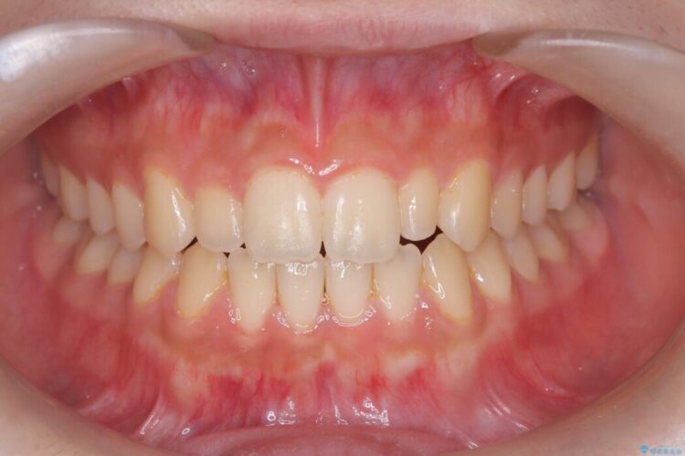 【インビザライン】未萌出の永久歯と八重歯をなおしたい。 アフター