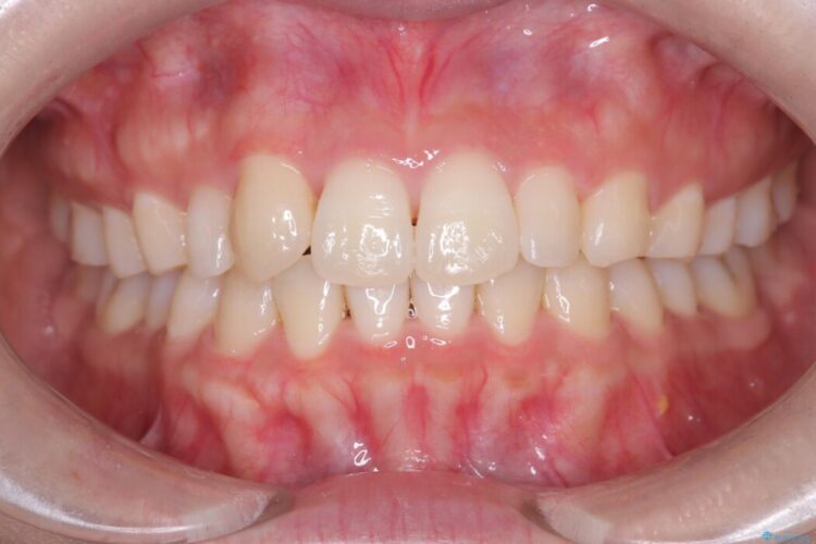 気になる飛び出た八重歯を歯科矯正で治したい 治療後画像