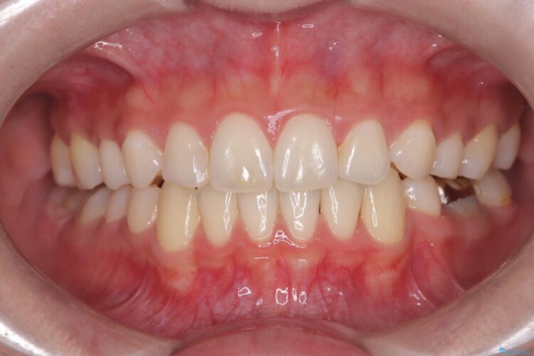 飛び出た犬歯と八重歯をなおしたい 治療後画像