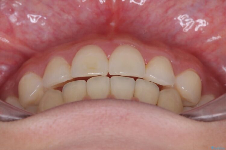 飛び出た犬歯と八重歯をなおしたい 治療後画像
