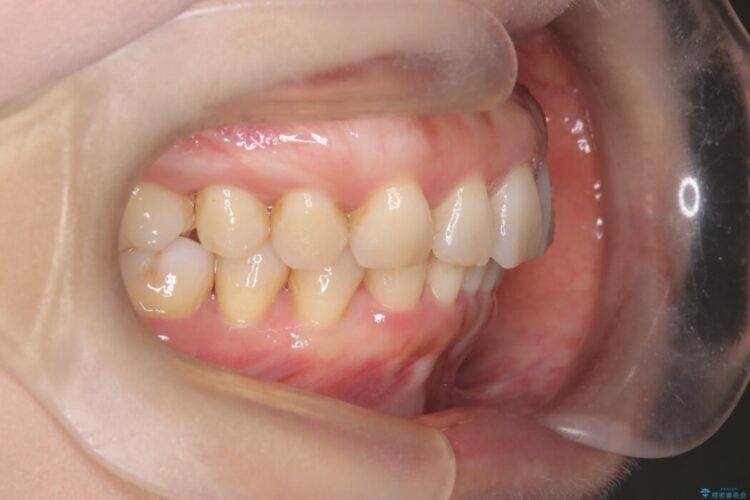 出っ歯をインビザラインで改善 治療後画像