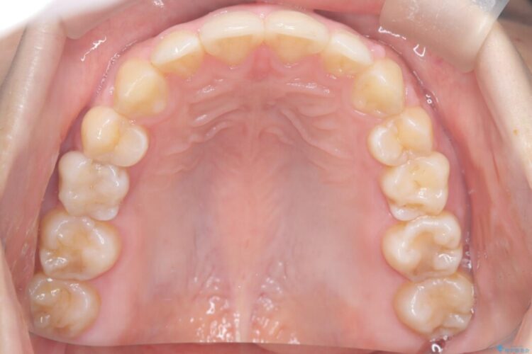 【ワイヤー矯正】前歯の叢生(ガタガタ)をなおす 治療後画像