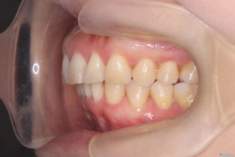 出っ歯をインビザラインで改善 治療後画像
