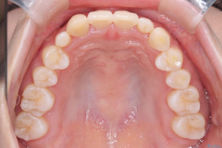 気になる飛び出た八重歯を歯科矯正で治したい 治療後画像