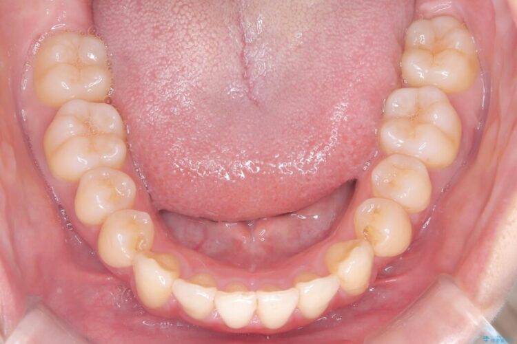 アンカースクリューを使用した前歯の遠心移動 治療後画像