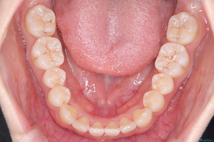 気になる飛び出た八重歯を歯科矯正で治したい 治療後画像
