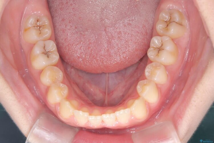 【インビザライン】未萌出の永久歯と八重歯をなおしたい。 治療後画像