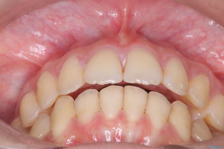 アンカースクリューを使用した前歯の遠心移動 治療後画像