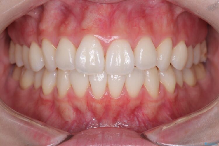 【インビザライン】前歯のねじれを改善 治療後画像