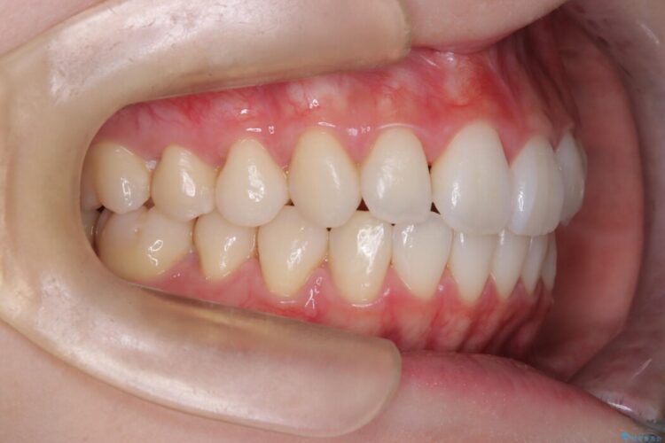 【インビザライン】前歯のねじれを改善 治療後画像
