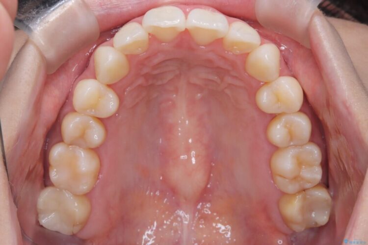 【インビザライン】前歯のねじれを改善 治療後画像