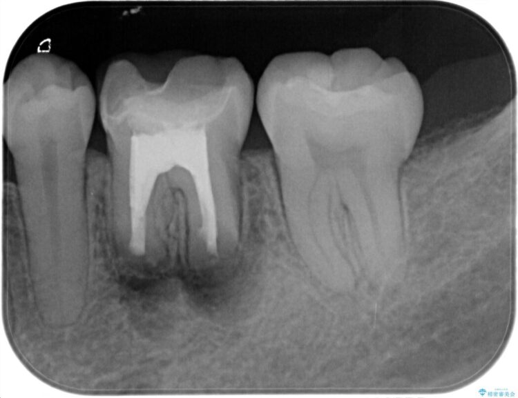 根尖性歯周炎の再発を歯根端切除術で治療する 治療途中画像