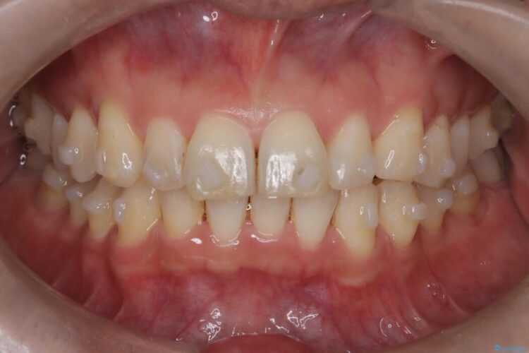 前歯のガタつきを改善したい 治療途中画像