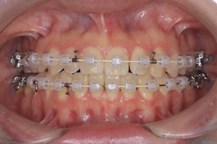 上下の前歯がぶつかって隙間が空いてしまう噛み合わせをなおす 治療途中画像