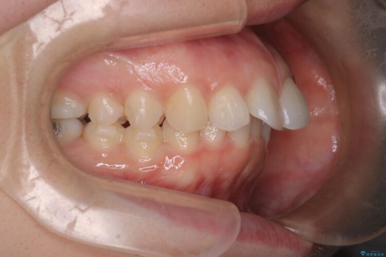飛び出た前歯の形を変えたい 治療途中画像