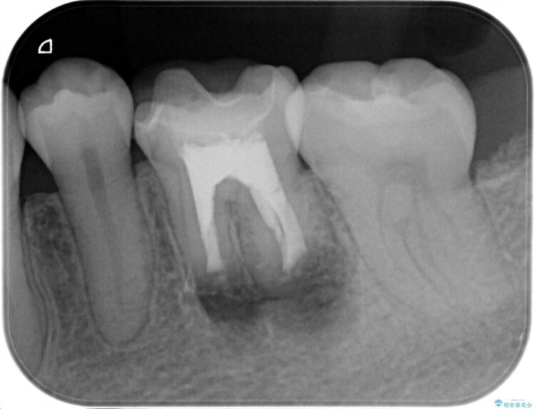 根尖性歯周炎の再発を歯根端切除術で治療する 治療途中画像