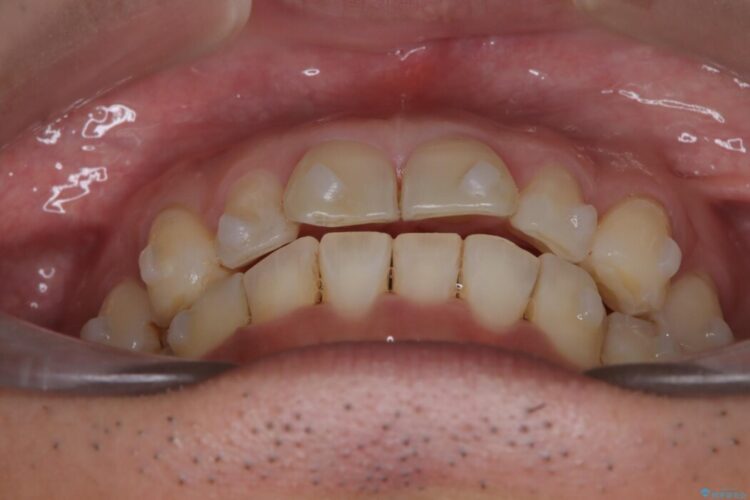 前歯のガタつきを改善したい 治療途中画像