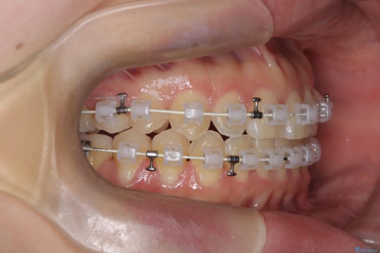 上下の前歯がぶつかって隙間が空いてしまう噛み合わせをなおす 治療途中画像