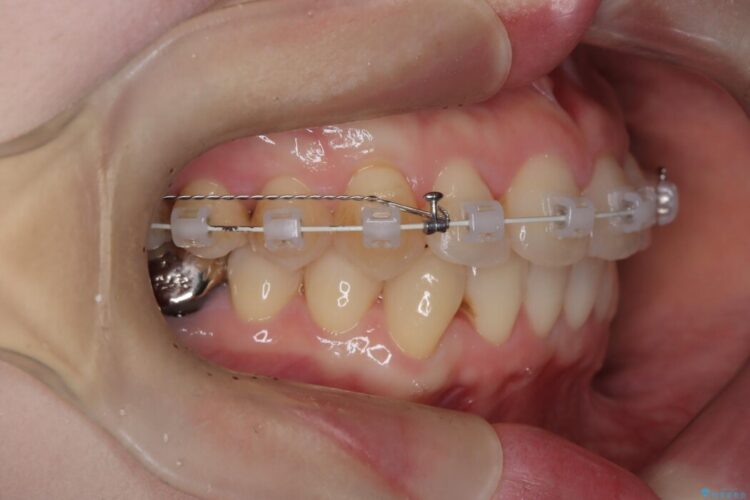 前歯の翼状捻転（ねじれ）をきれいな歯列へ 治療途中画像