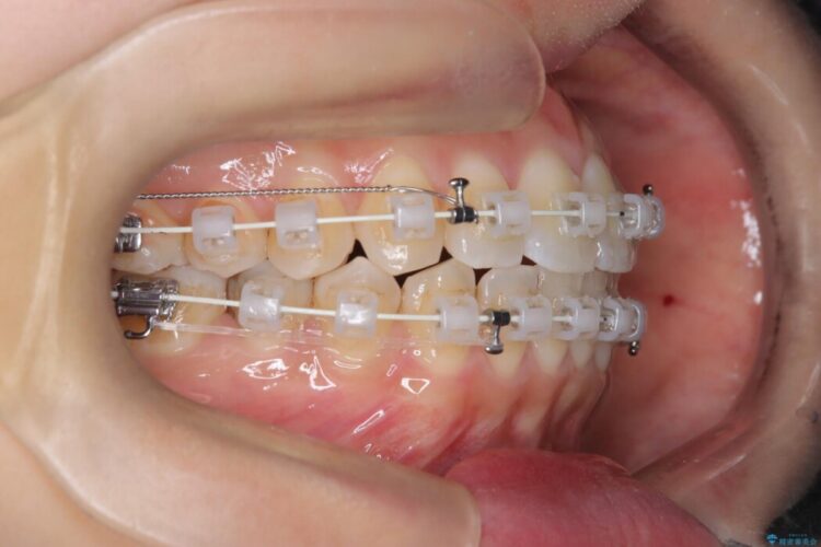 軽度のガタつきを納得のいく歯列へワイヤー矯正 治療途中画像
