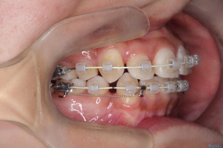 引っ込んだ前歯が目立つガタガタな歯列を抜歯矯正 治療途中画像