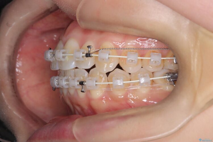 軽度のガタつきを納得のいく歯列へワイヤー矯正 治療途中画像