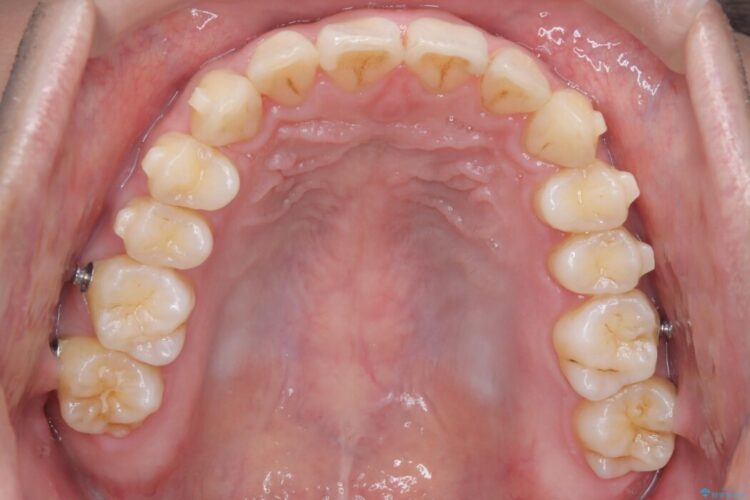 上顎前突（出っ歯）をインビザラインで矯正治療 治療途中画像