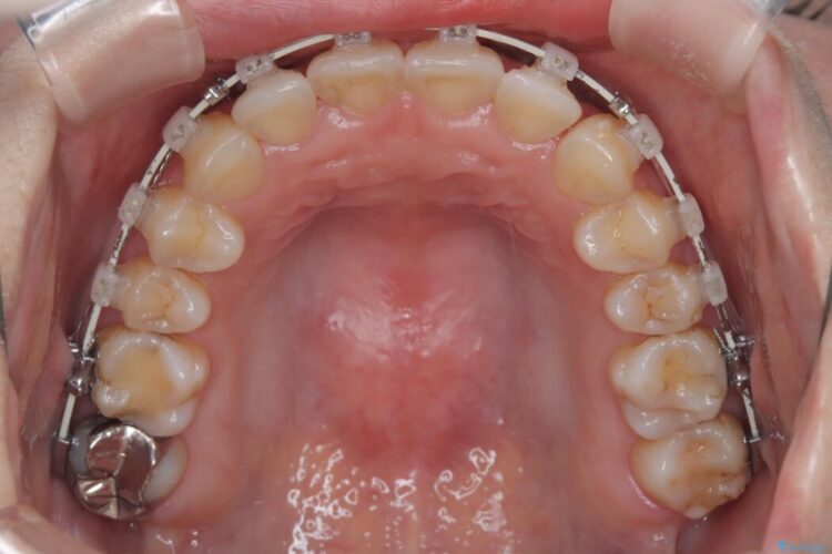 前歯の翼状捻転（ねじれ）をきれいな歯列へ 治療途中画像