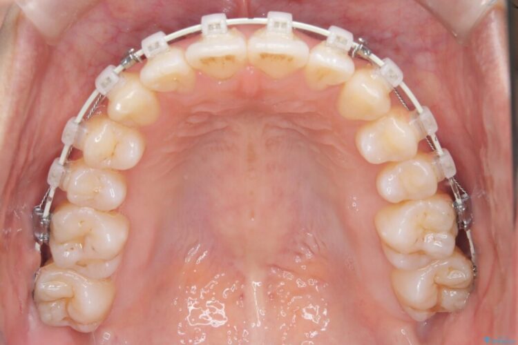軽度のガタつきを納得のいく歯列へワイヤー矯正 治療途中画像