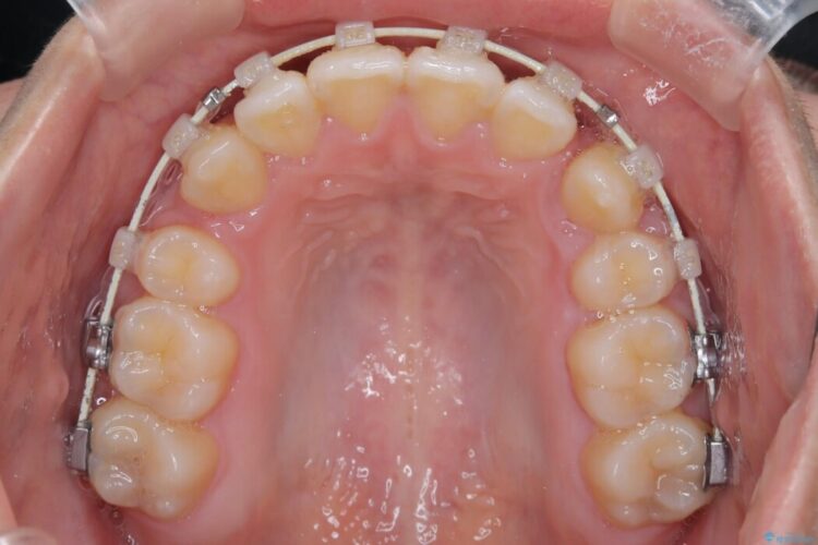 上顎埋伏犬歯の牽引による歯列矯正 治療途中画像