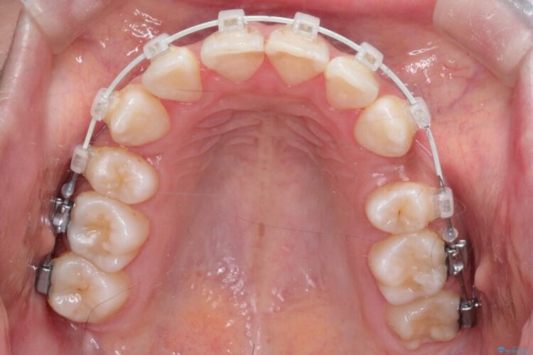 引っ込んだ前歯が目立つガタガタな歯列を抜歯矯正 治療途中画像