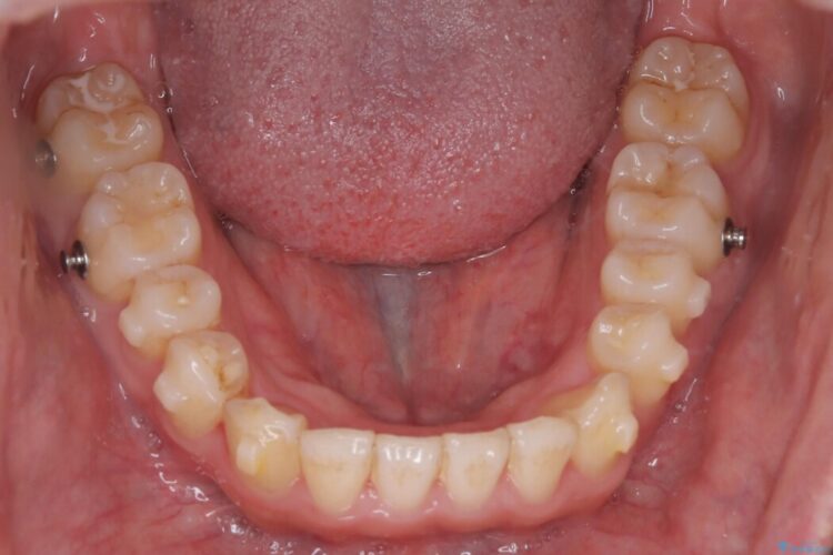 上顎前突（出っ歯）をインビザラインで矯正治療 治療途中画像