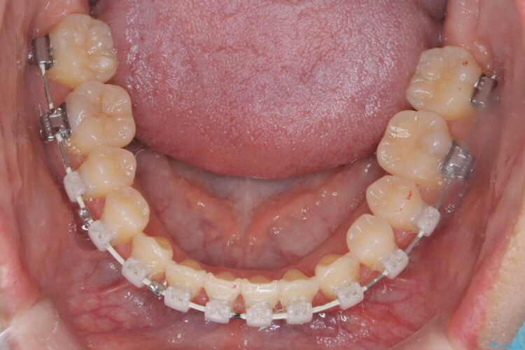 上下の前歯がぶつかって隙間が空いてしまう噛み合わせをなおす 治療途中画像
