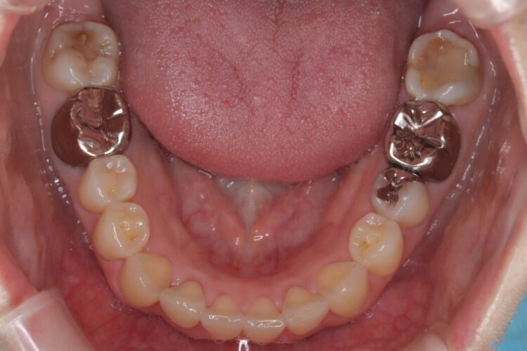 前歯の翼状捻転（ねじれ）をきれいな歯列へ 治療途中画像