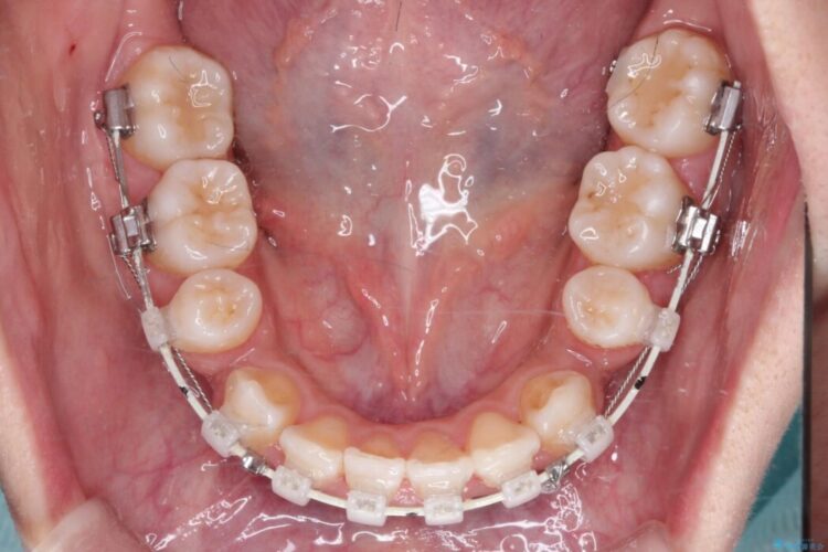 引っ込んだ前歯が目立つガタガタな歯列を抜歯矯正 治療途中画像