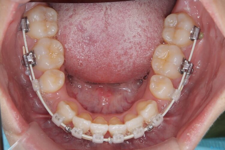 上顎埋伏犬歯の牽引による歯列矯正 治療途中画像