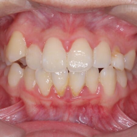 上顎埋伏犬歯の牽引による歯列矯正 治療前