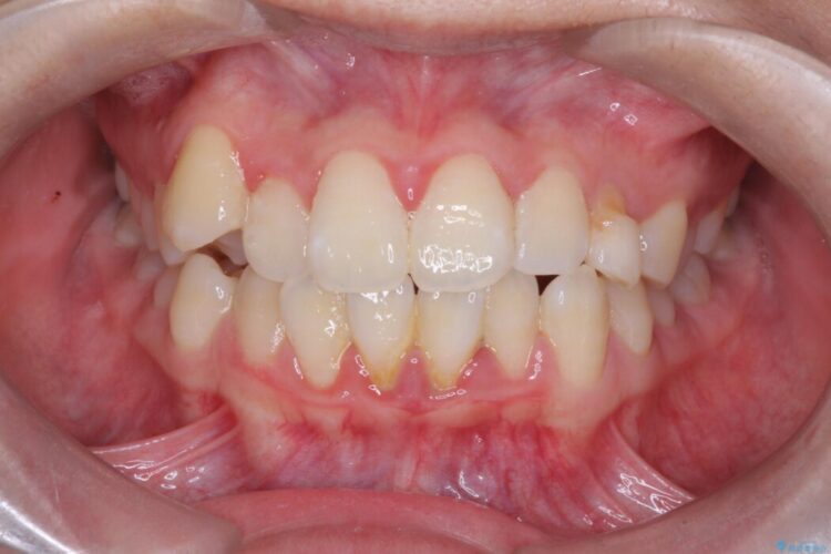 上顎埋伏犬歯の牽引による歯列矯正 ビフォー
