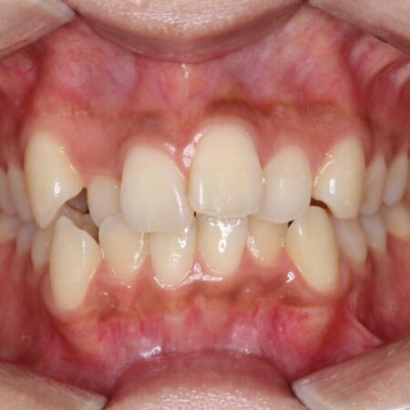 引っ込んだ前歯が目立つガタガタな歯列を抜歯矯正 治療前