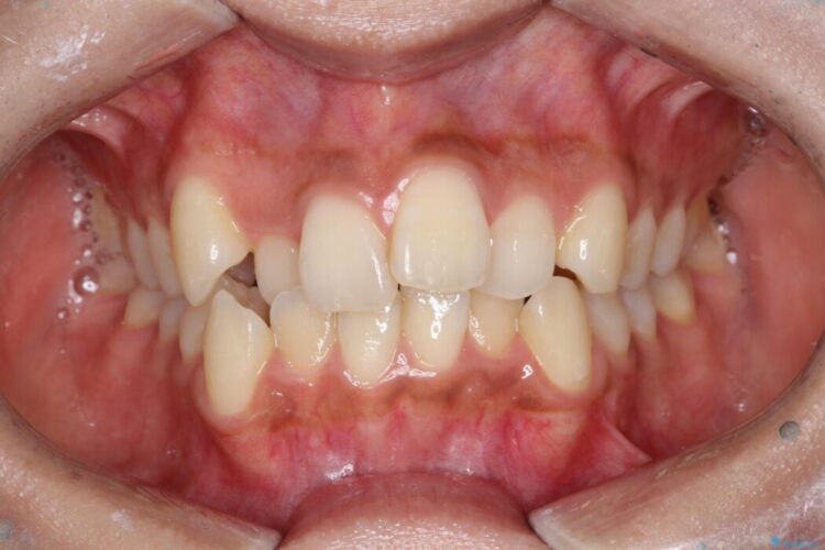 引っ込んだ前歯が目立つガタガタな歯列を抜歯矯正 ビフォー