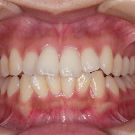 前歯のガタつき（叢生）をきれいに整える 治療前