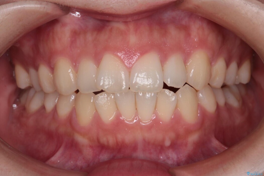 前歯の凸凹をインビザラインできれいなアーチに 治療前