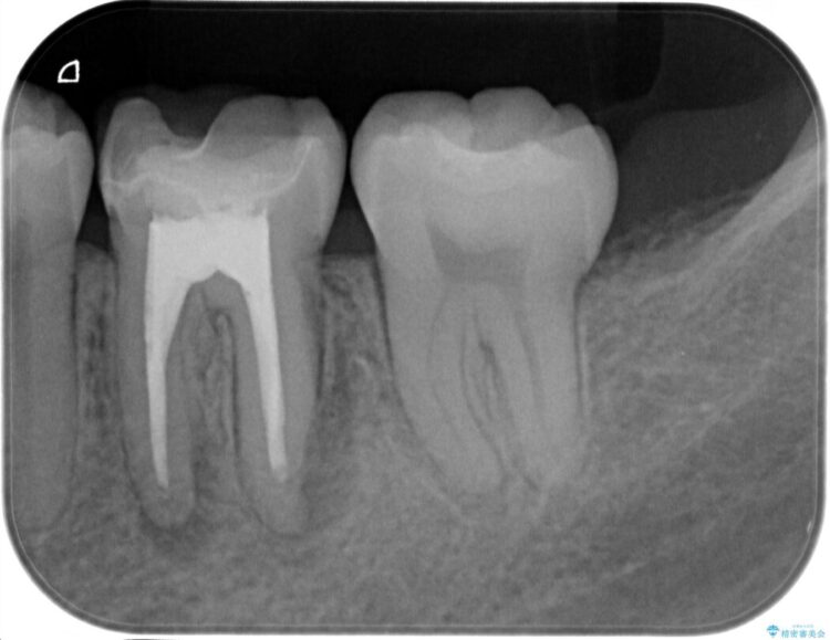 根尖性歯周炎の再発を歯根端切除術で治療する ビフォー