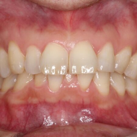 前歯のガタつきを改善したい 治療前
