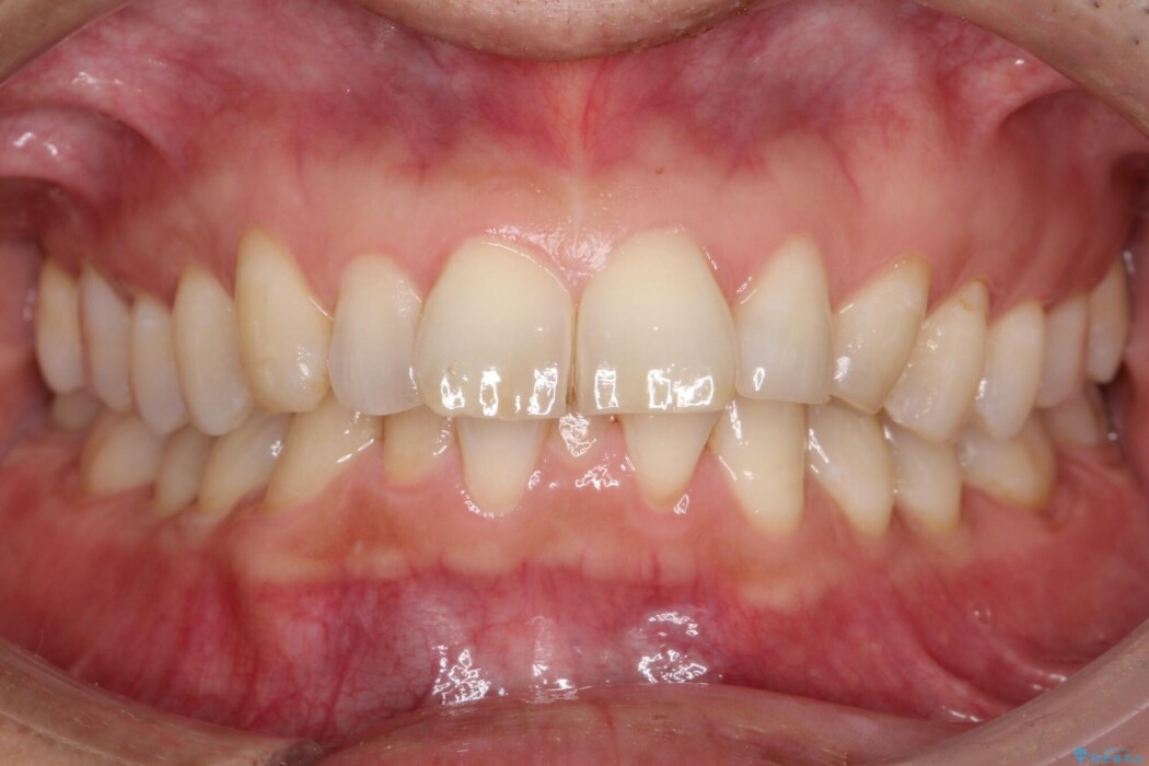 前歯のガタつきを改善したい 治療前
